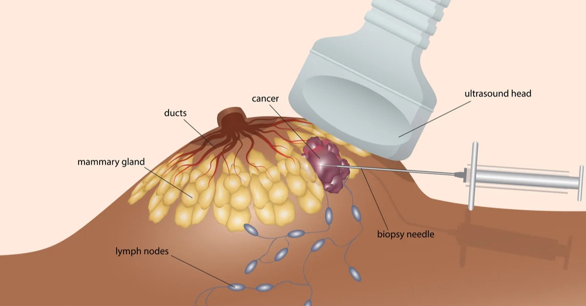 Biopsii mamare
